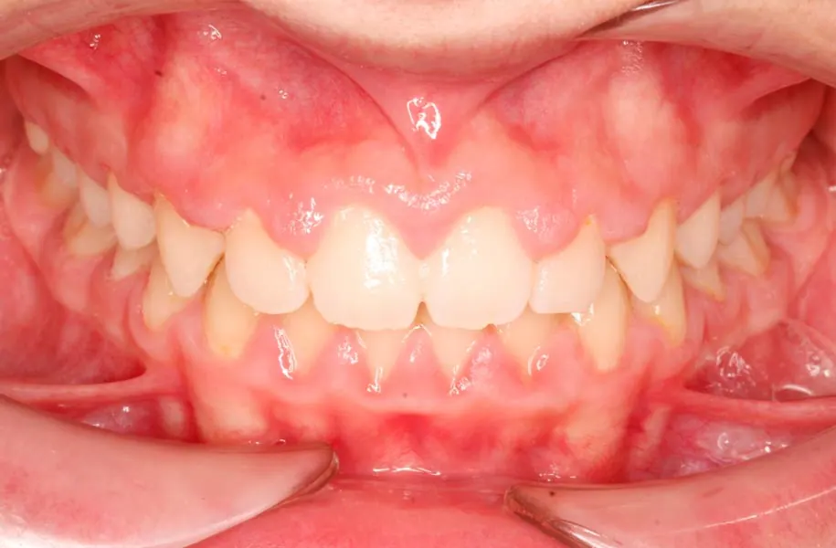 After children's orthodontics in málaga treatment at ByB Dental