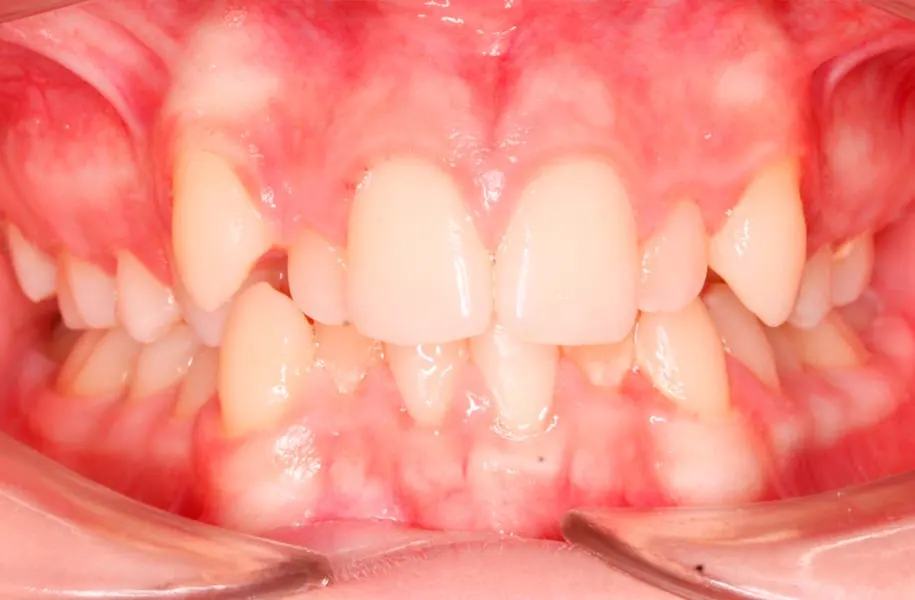 Before children's orthodontics in málaga treatment at ByB Dental