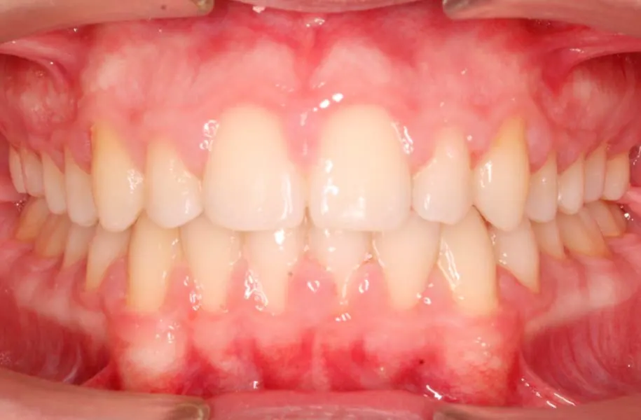After children's orthodontics in málaga treatment at ByB Dental