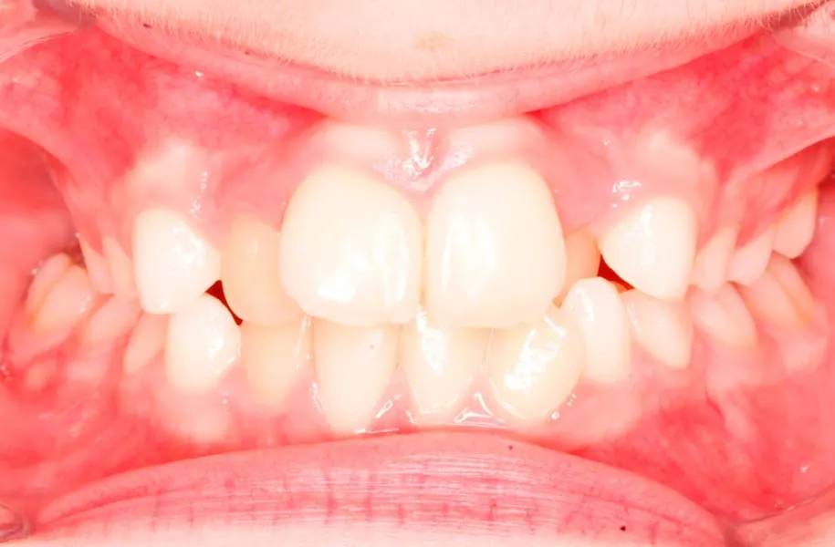 Before children's orthodontics in málaga treatment at ByB Dental