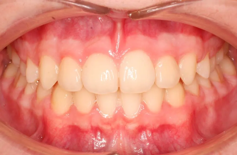 After children's orthodontics in málaga treatment at ByB Dental