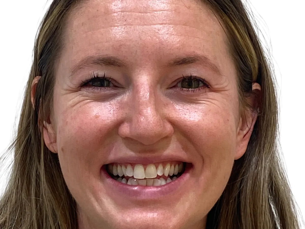 Before invisible orthodontics in málaga treatment at ByB Dental