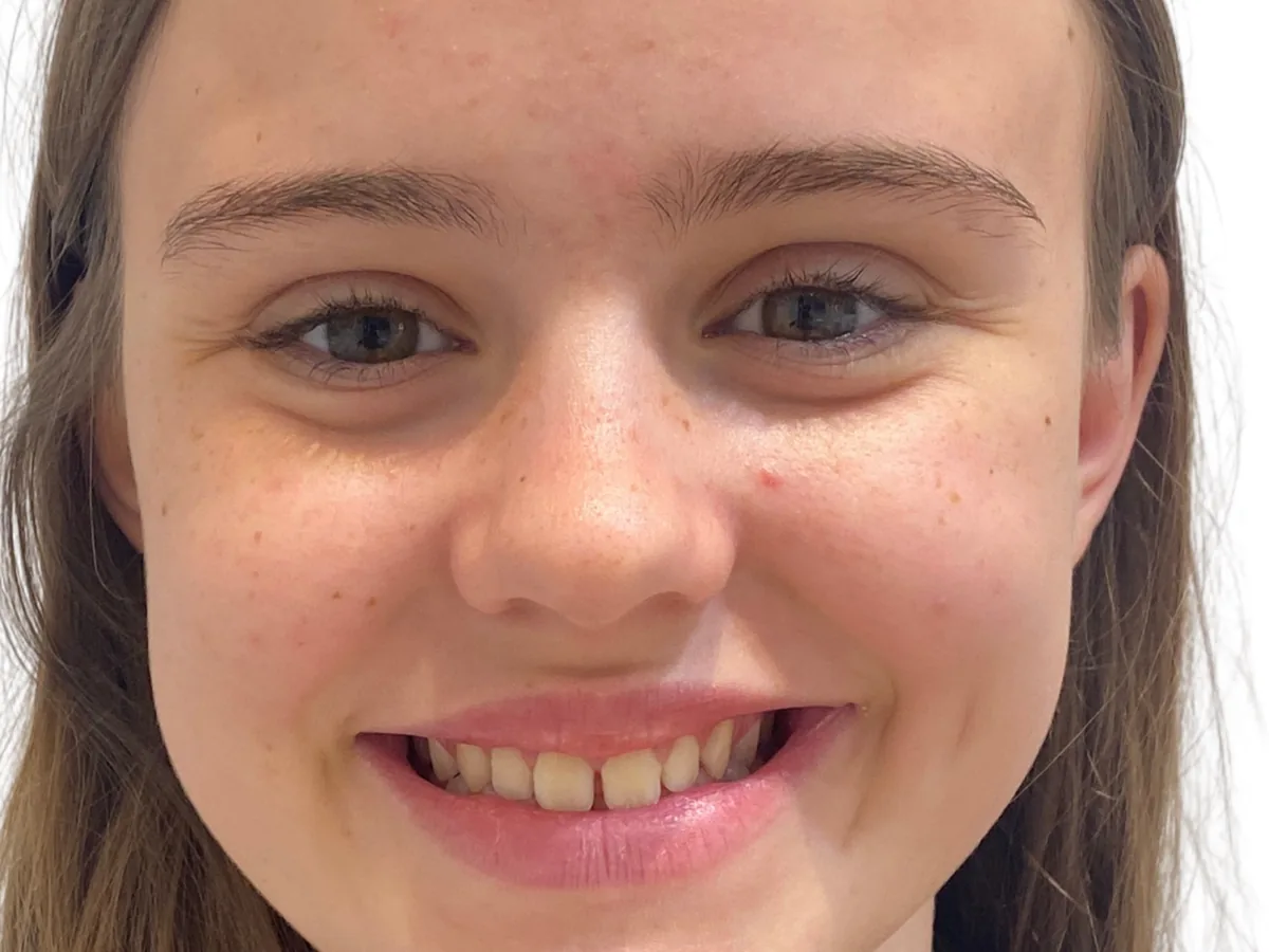 Before invisible orthodontics in málaga treatment at ByB Dental