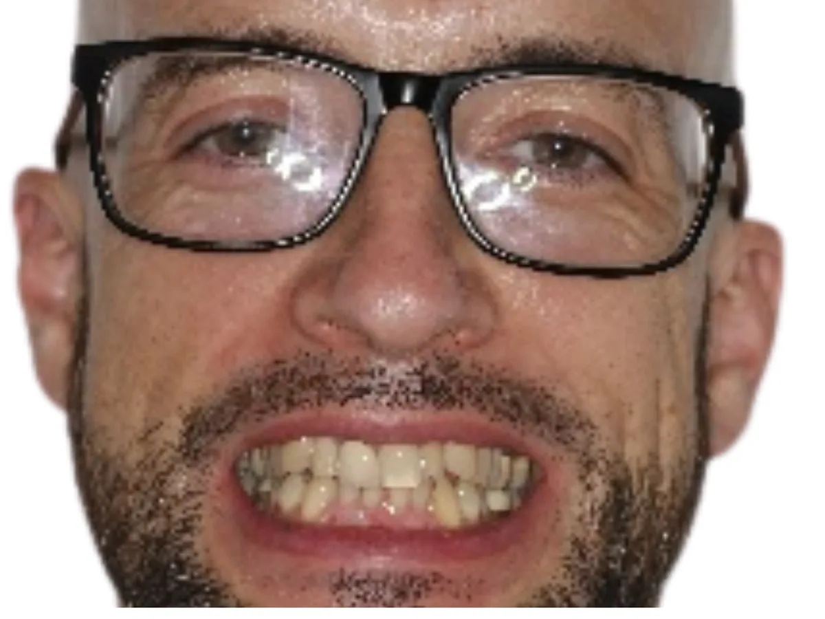 Before invisible orthodontics in málaga treatment at ByB Dental