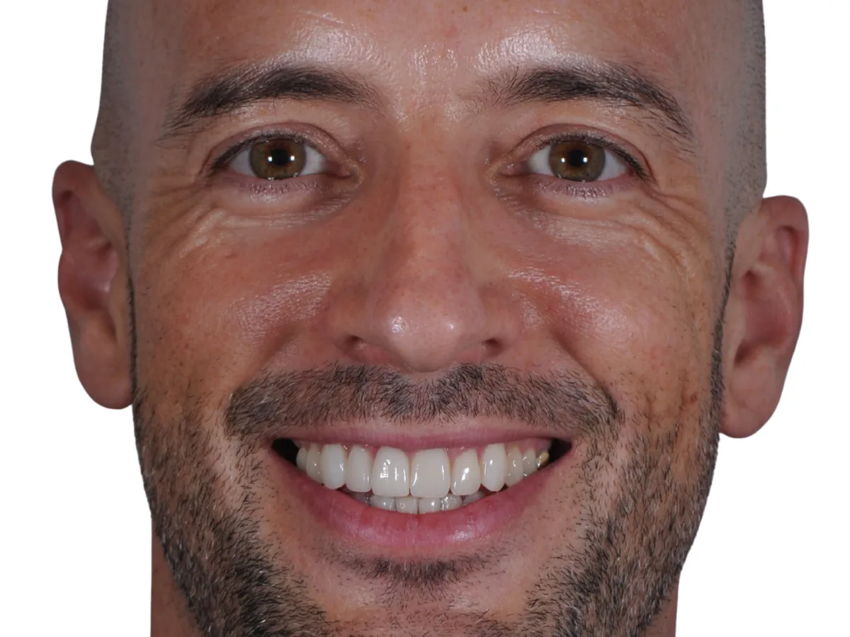 After invisible orthodontics in málaga treatment at ByB Dental