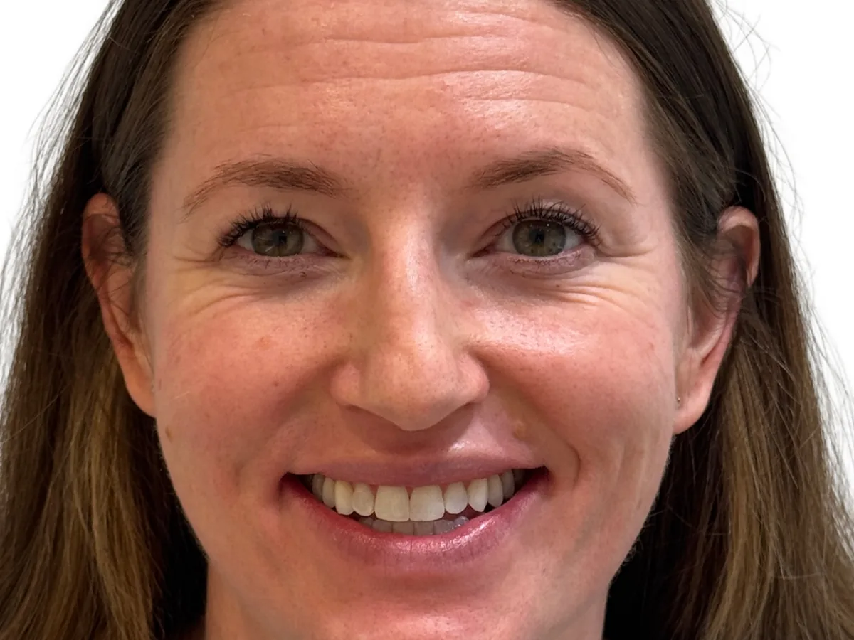 After orthodontics in málaga treatment at ByB Dental