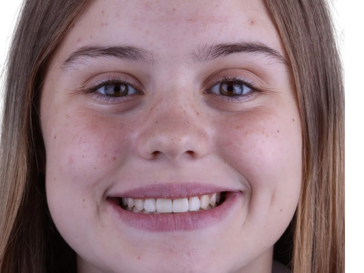 After orthodontics in málaga treatment at ByB Dental