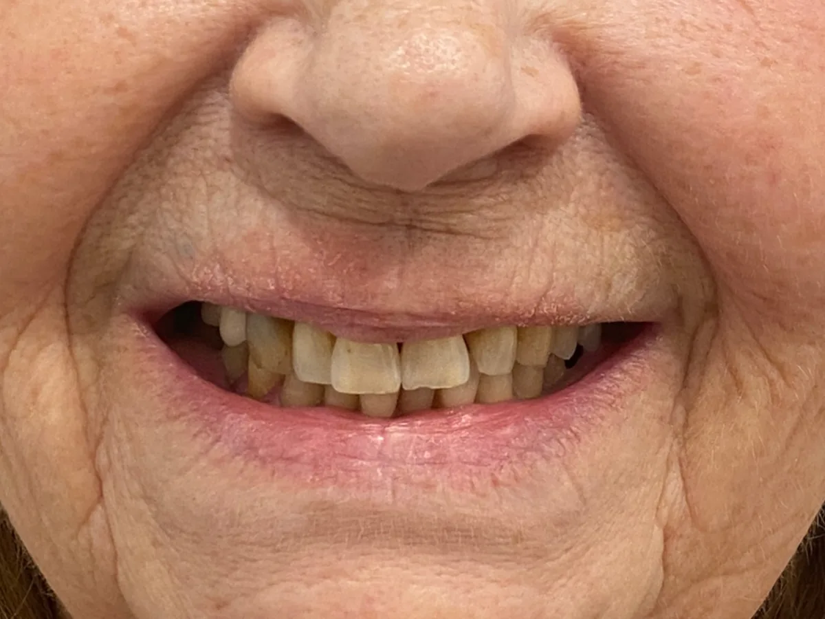 Before orthodontics in málaga treatment at ByB Dental