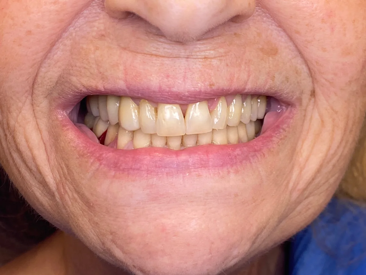 After orthodontics in málaga treatment at ByB Dental