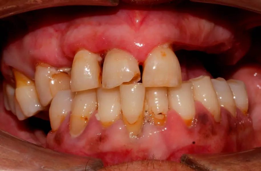 Before dental prostheses in málaga treatment at ByB Dental