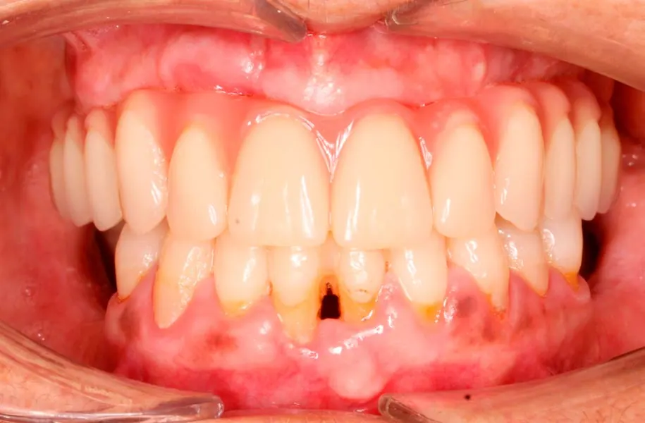 After dental prostheses in málaga treatment at ByB Dental