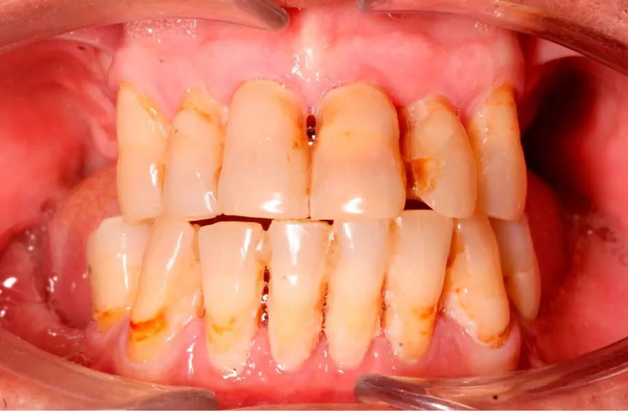 Before dental prostheses in málaga treatment at ByB Dental
