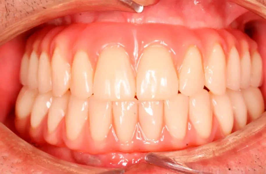 After dental prostheses in málaga treatment at ByB Dental