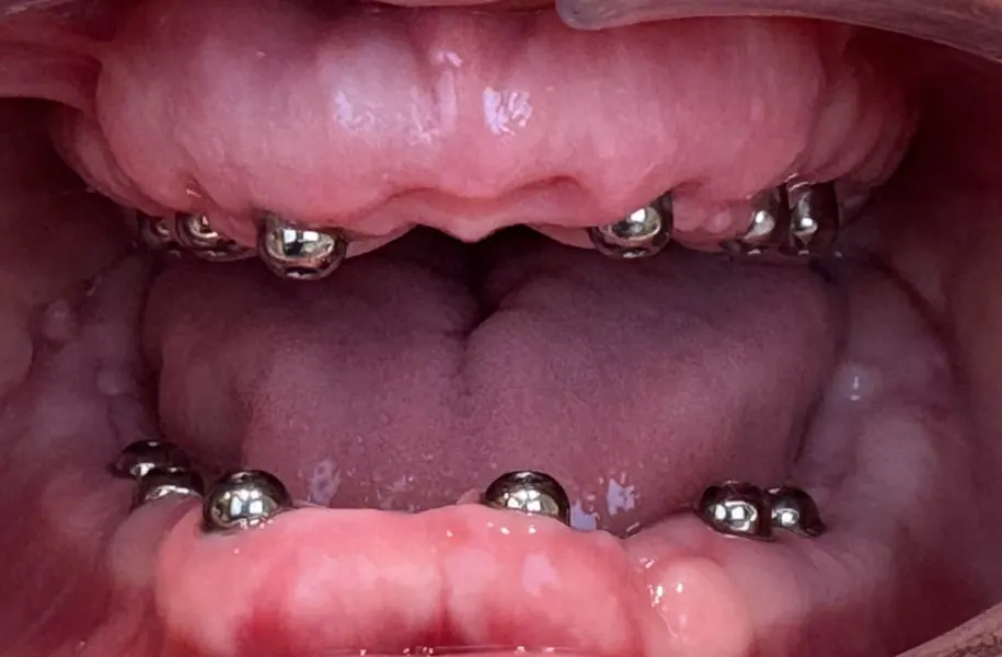 Before dental prostheses in málaga treatment at ByB Dental