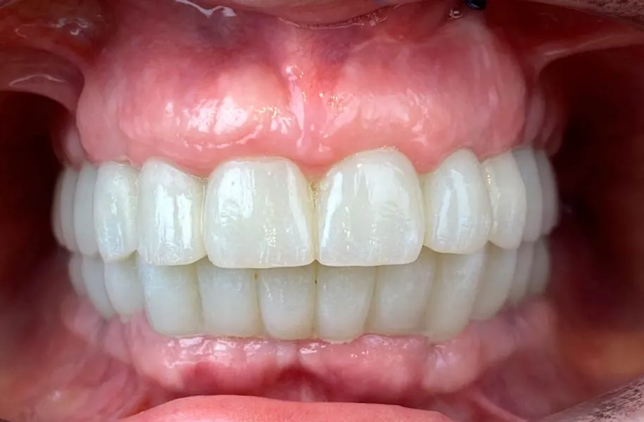 After dental prostheses in málaga treatment at ByB Dental