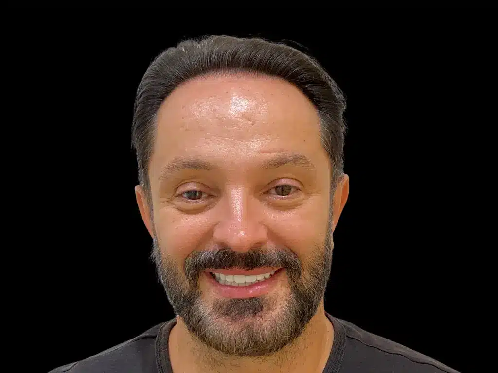 David Carrasco, real patient story at ByB Dental