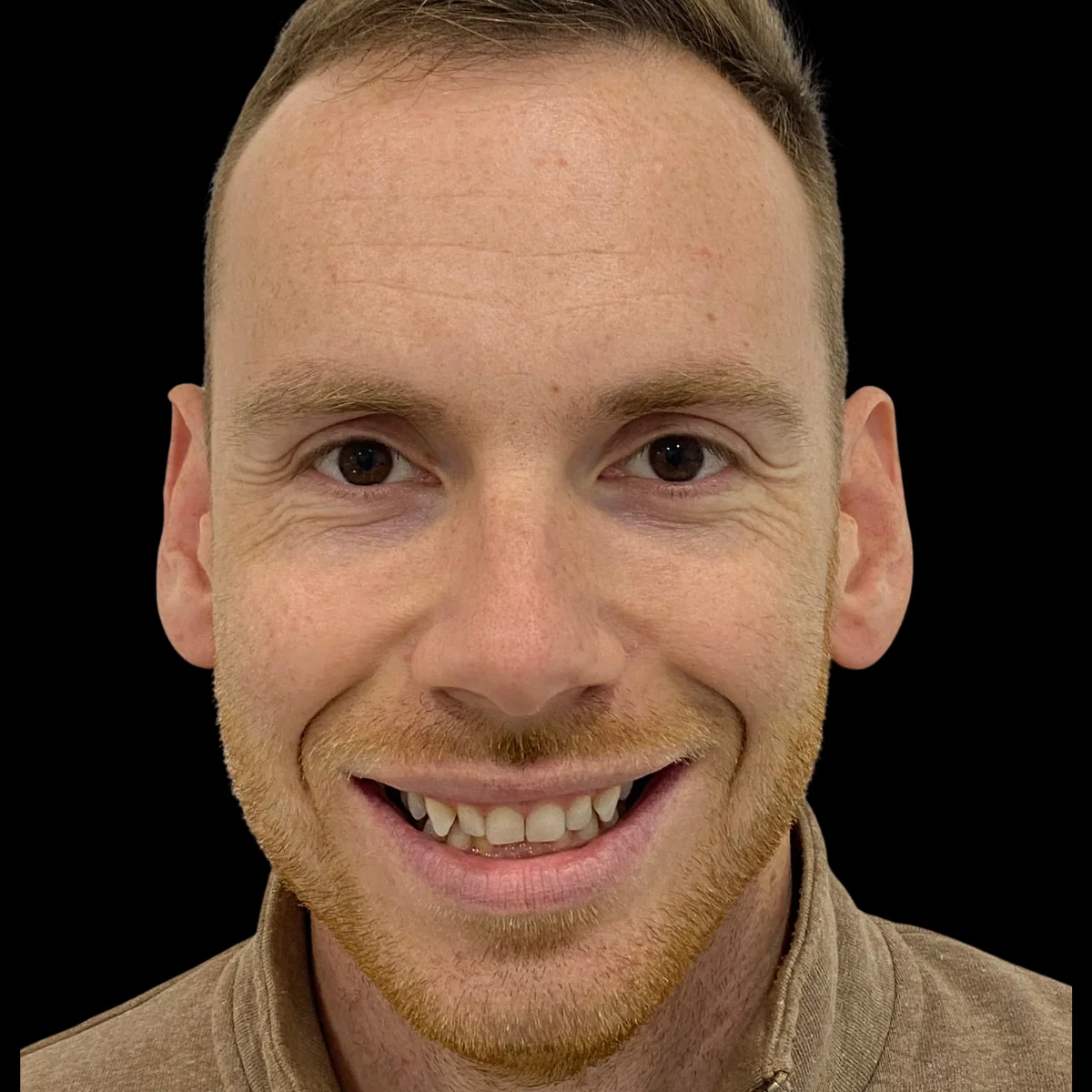 Sonrisa de Dennis antes del tratamiento de ortodoncia y carillas en ByB Dental (Málaga)