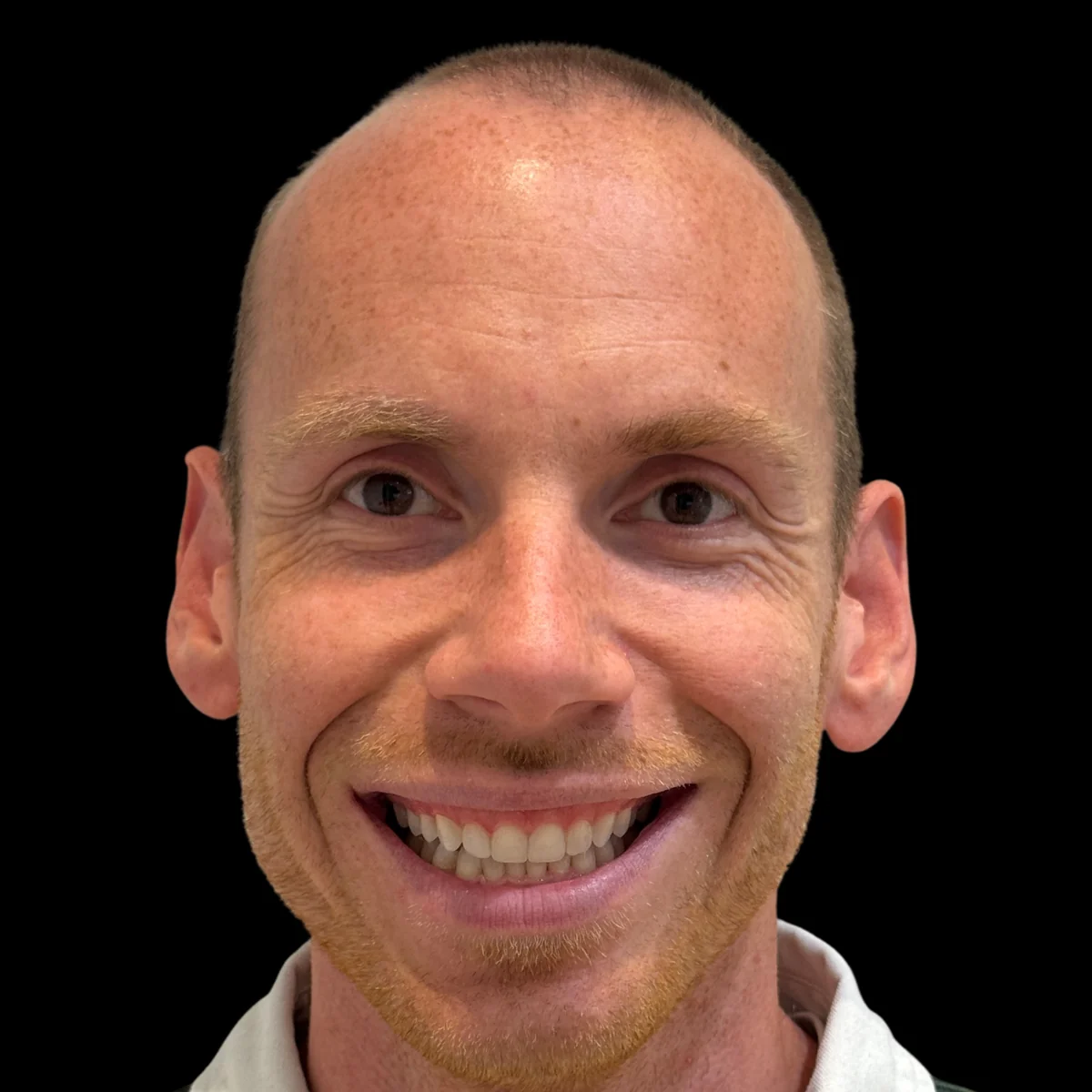 Sonrisa de Dennis después del tratamiento de ortodoncia invisible y carillas de composite en ByB Dental (Málaga)