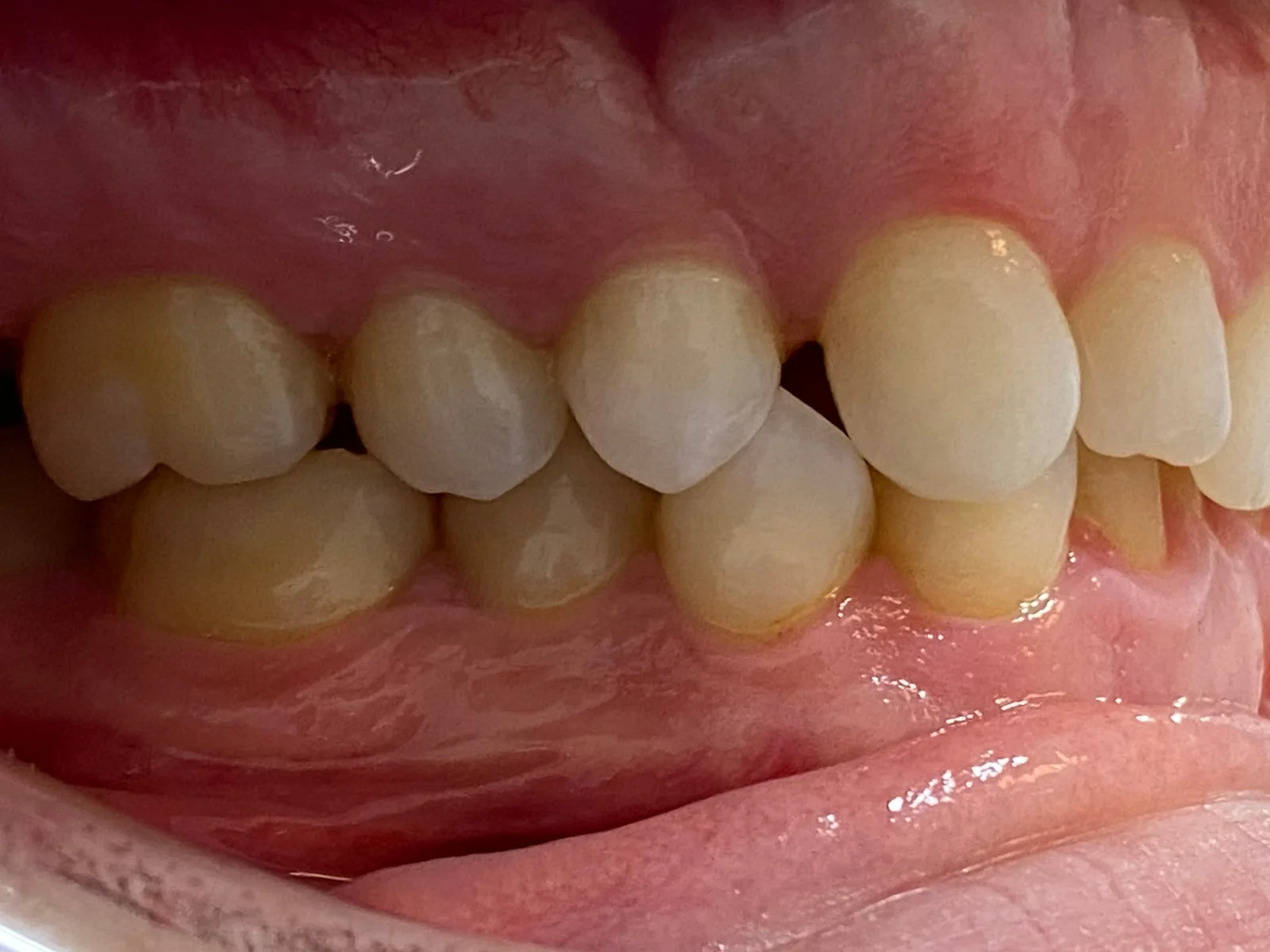 Vista lateral derecha de los dientes de Dennis antes del tratamiento en ByB Dental