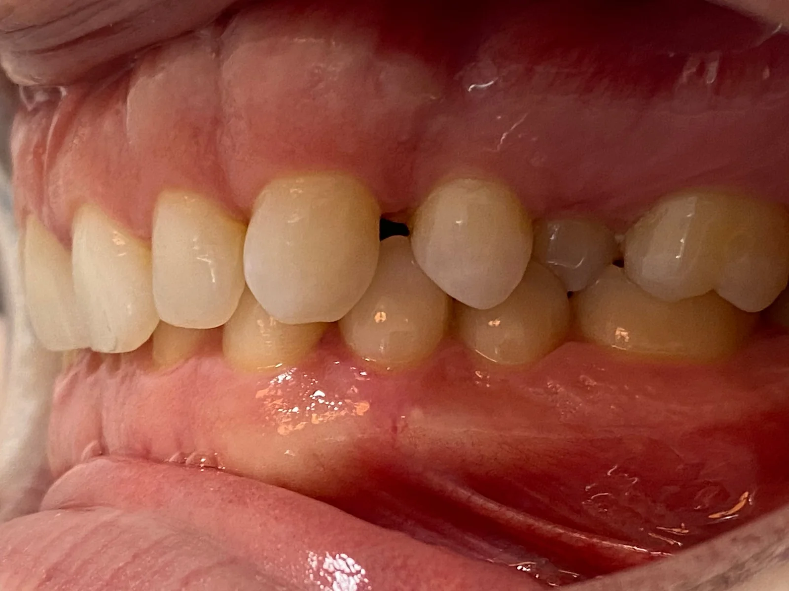 Vista lateral izquierda de los dientes de Dennis antes del tratamiento en ByB Dental