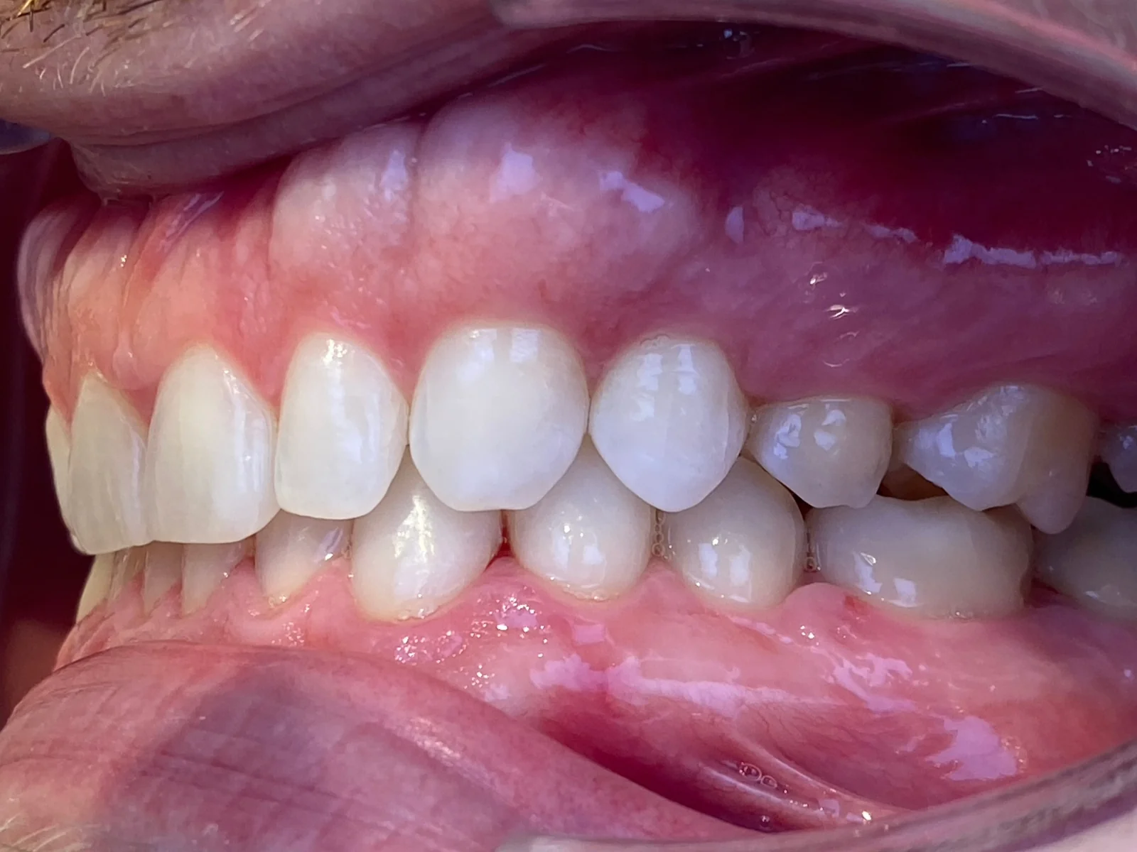 Vista lateral izquierda de los dientes de Dennis después del tratamiento en ByB Dental