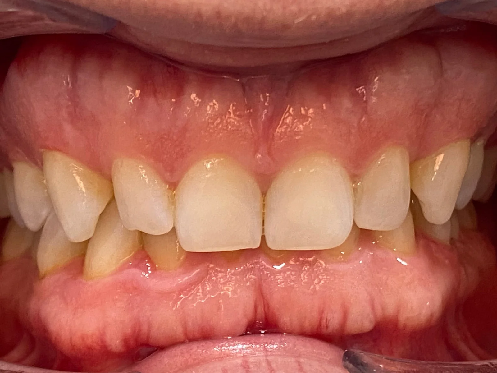 Sonrisa de Dennis de frente antes del tratamiento en ByB Dental