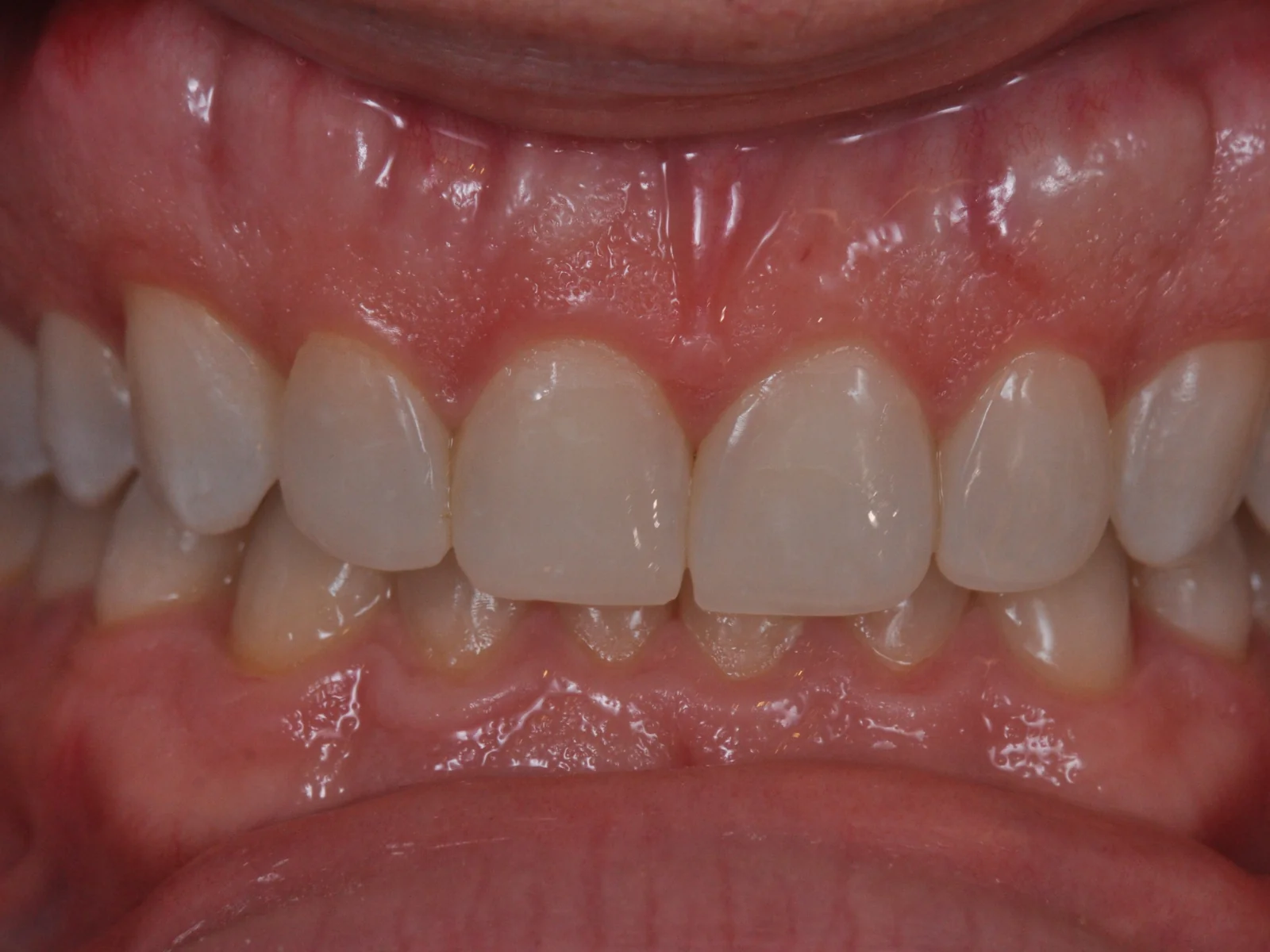 Sonrisa de Dennis de frente después de la ortodoncia y las carillas de composite en ByB Dental