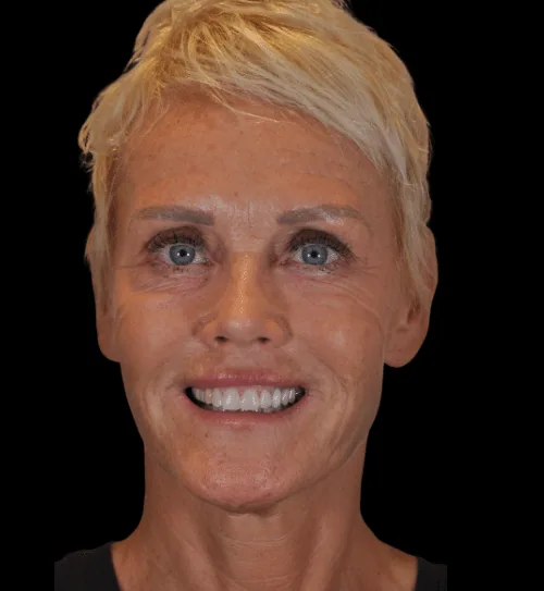Before treatment: Natja