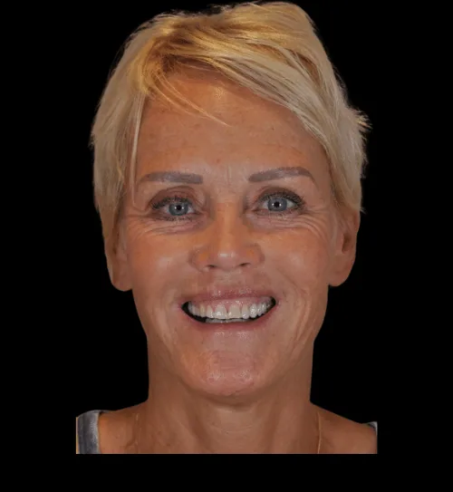 After treatment: Natja