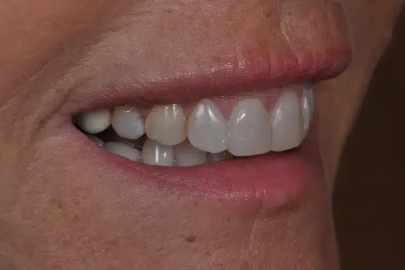 Before treatment: Natja