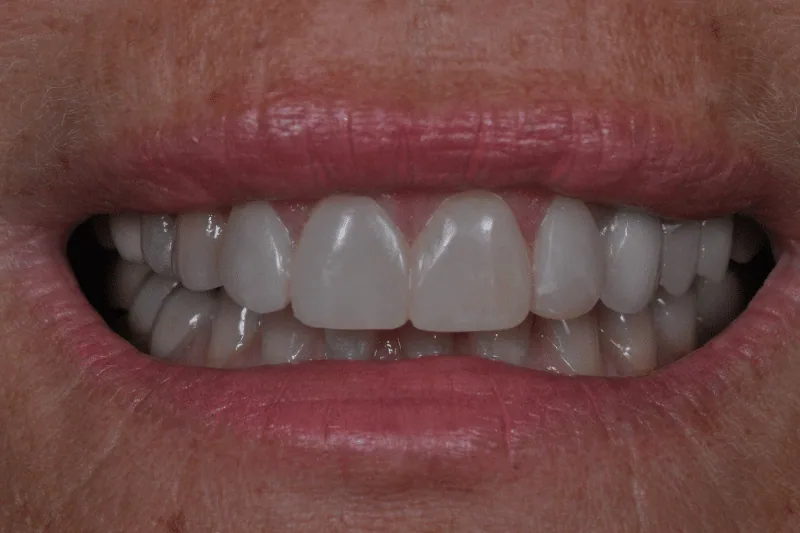 After treatment: Natja