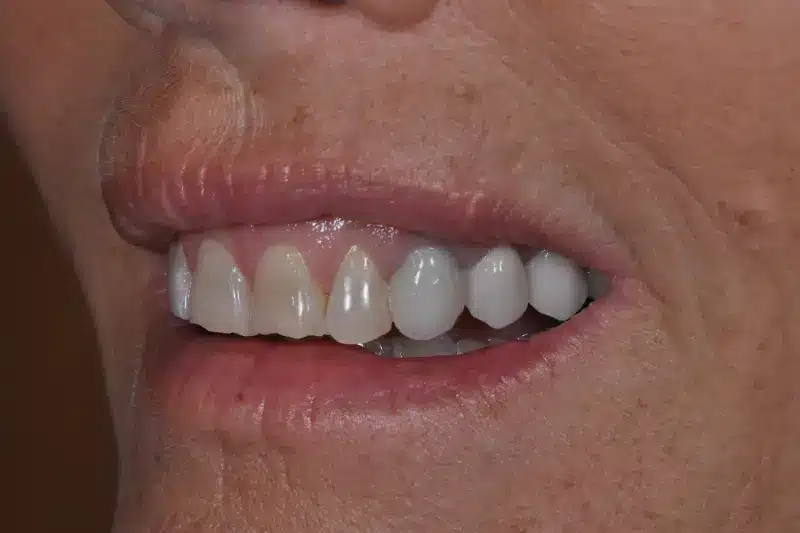 Before treatment: Natja