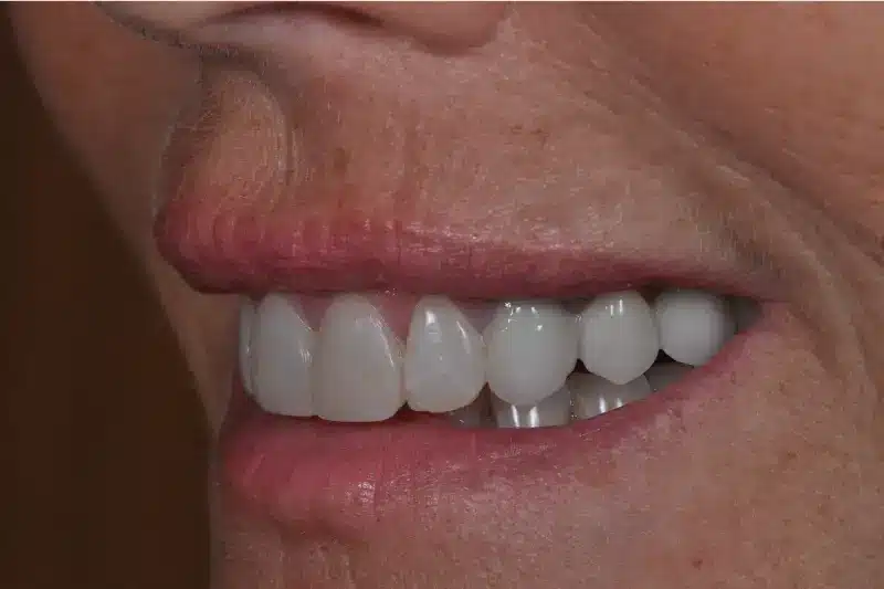 After treatment: Natja