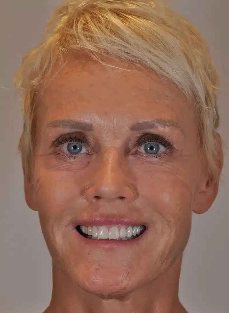 Resultado frontal del tratamiento de Natja