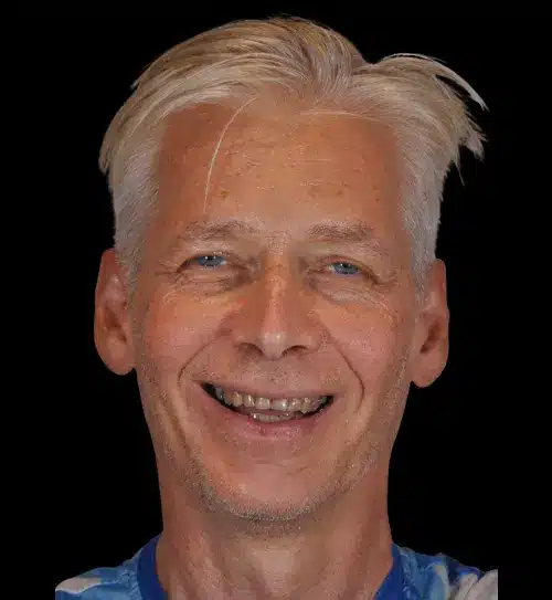 Before treatment: Nils