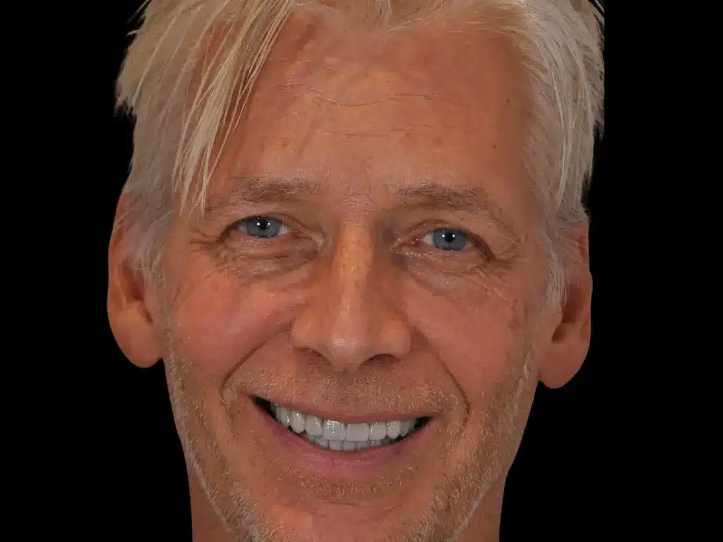 Nils, real patient story at ByB Dental