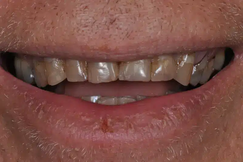 Before treatment: Nils