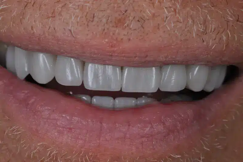 After treatment: Nils