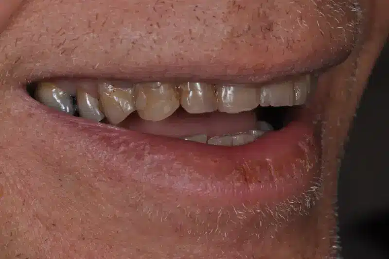 Before treatment: Nils