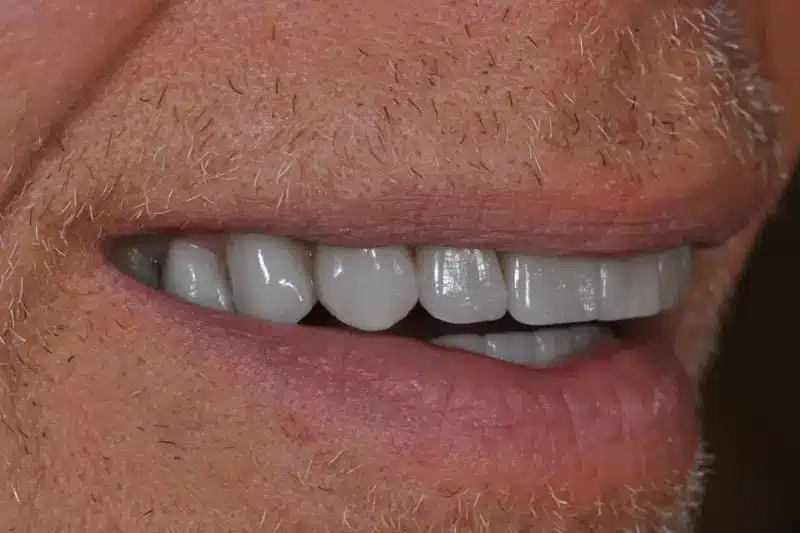 After treatment: Nils