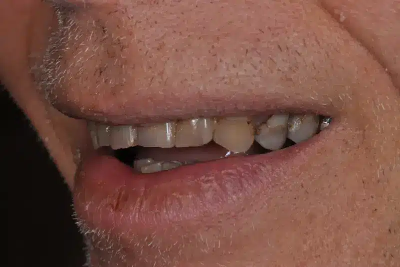 Before treatment: Nils
