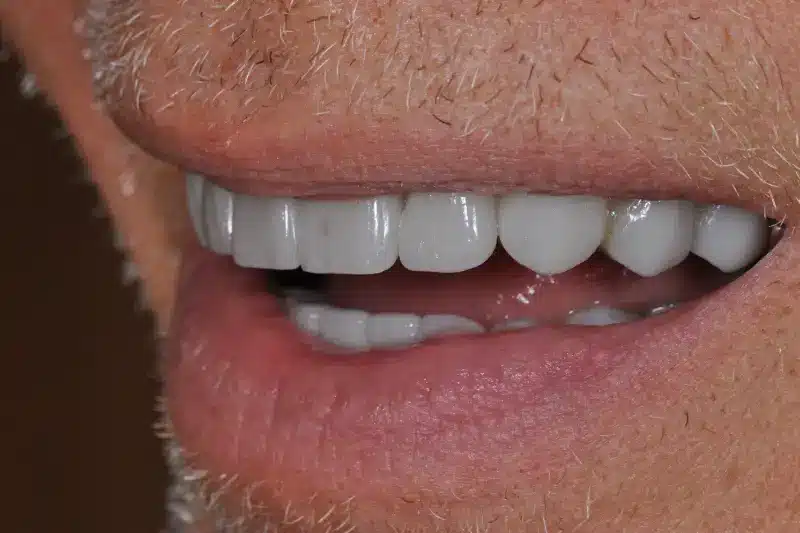 After treatment: Nils