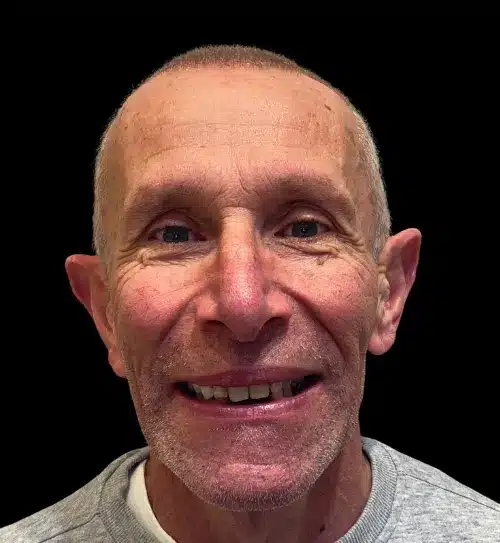 Before treatment: Richard