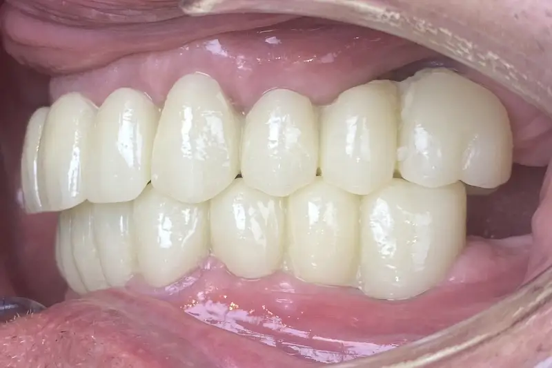 After treatment: Richard