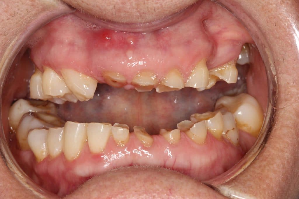 ¿Por qué el bruxismo es un gran problema y cómo solucionarlo?