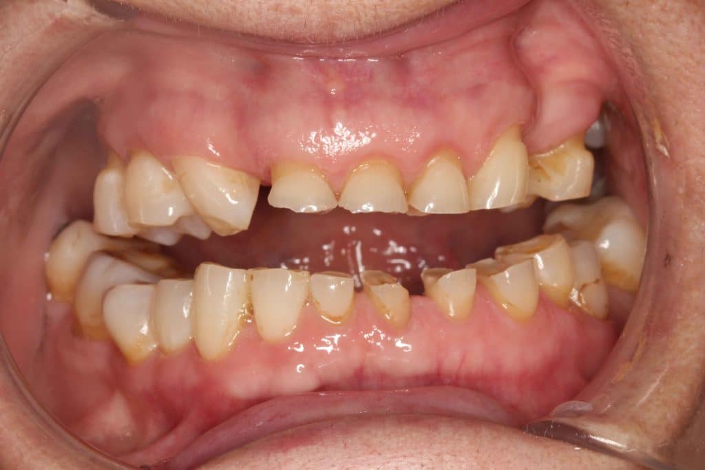 ¿Por qué el bruxismo es un gran problema y cómo solucionarlo?