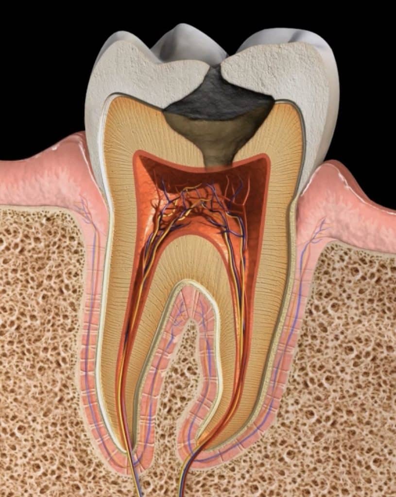 Caries Dentales, todo lo que necesitas saber.