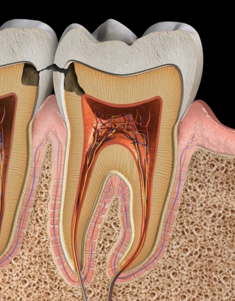 Caries Dentales, todo lo que necesitas saber.