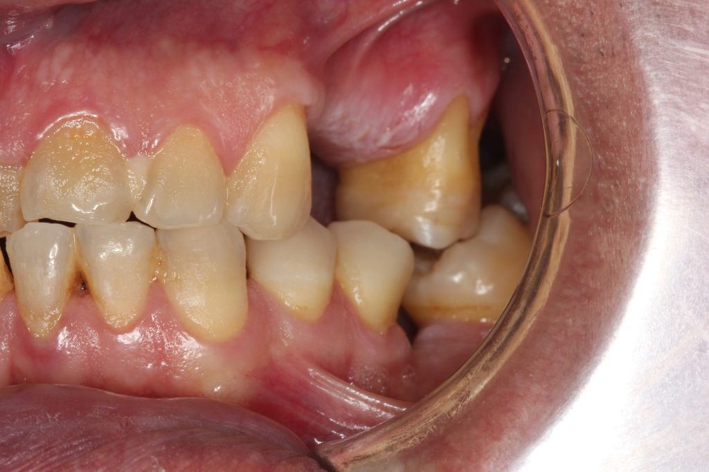 ¿Por qué reponer los dientes perdidos es crucial para tu salud?