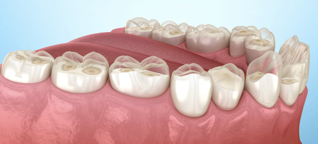 ¿Por qué el bruxismo es un gran problema y cómo solucionarlo?